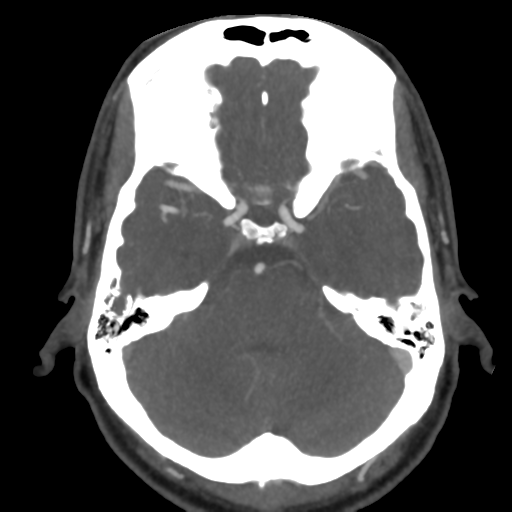 Cerebral arteriovenous malformation (Radiopaedia 39259-41505 AX CEREBRAL CTA 17).png