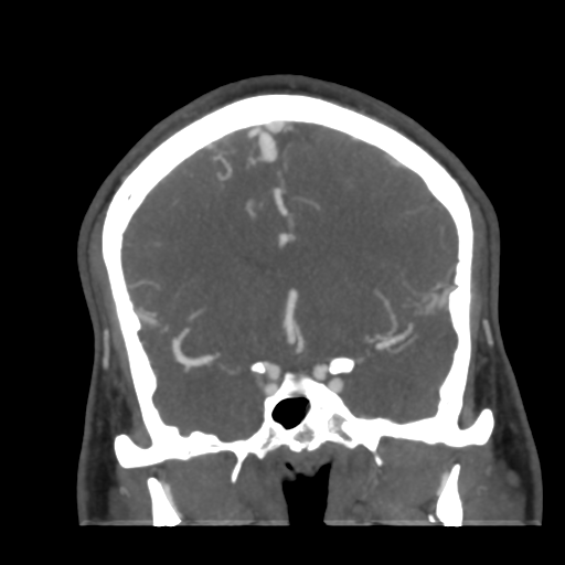 Cerebral arteriovenous malformation (Radiopaedia 39259-41505 E 26).png