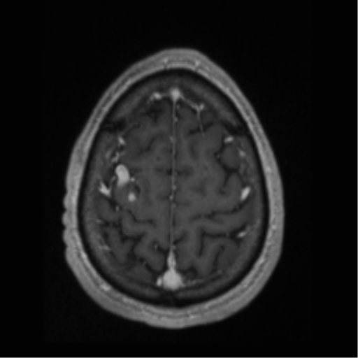 Cerebral arteriovenous malformation (Radiopaedia 55798-62372 Axial T1 C+ 66).png