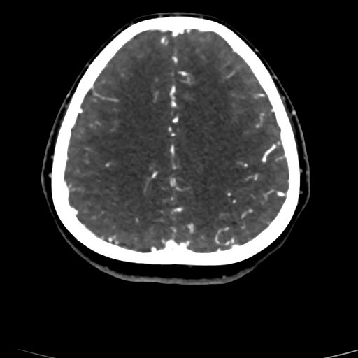 Cerebral arteriovenous malformation (Radiopaedia 73830-84645 Axial C+ delayed 24).jpg