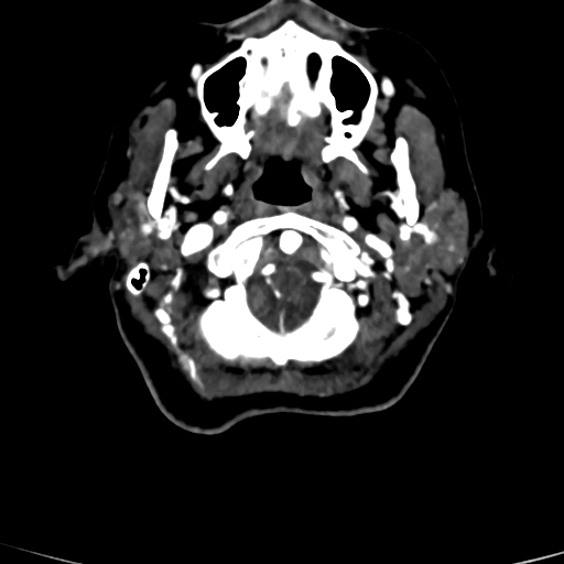 Cerebral arteriovenous malformation (Radiopaedia 73830-84645 Axial C+ delayed 89).jpg