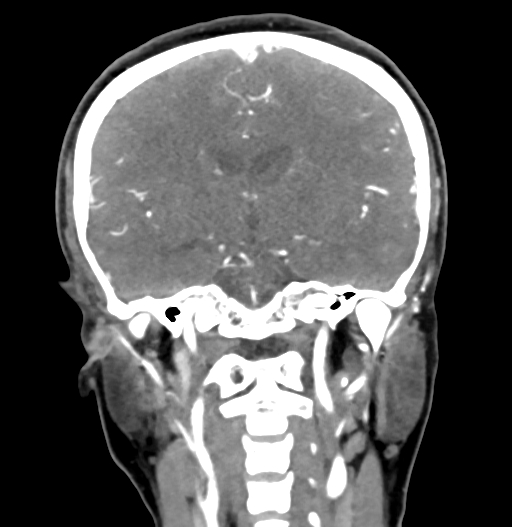 Cerebral arteriovenous malformation (Radiopaedia 73830-84645 C 52).jpg
