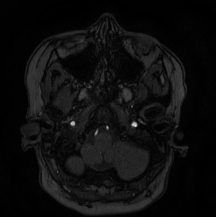 Cerebral arteriovenous malformation (Radiopaedia 74411-85654 Axial MRA 1).jpg