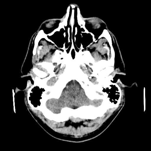 Cerebral arteriovenous malformation (Spetzler-Martin grade 2) (Radiopaedia 41262-44076 Axial non-contrast 10).png