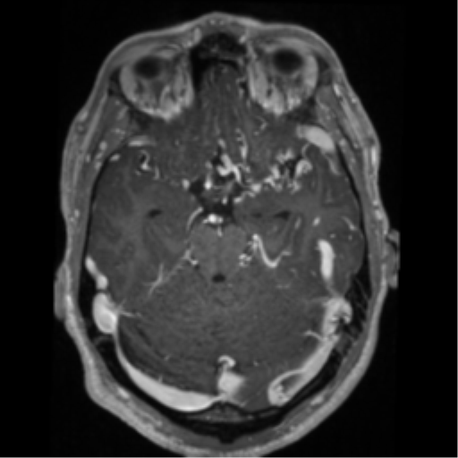 File:Cerebral arteriovenous malformation - huge (Radiopaedia 35734-37272 Axial T1 C+ 24).png