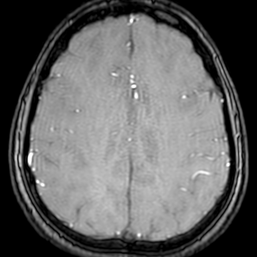 Cerebral arteriovenous malformation at posterior body of corpus callosum (Radiopaedia 74111-84925 Axial MRA 160).jpg
