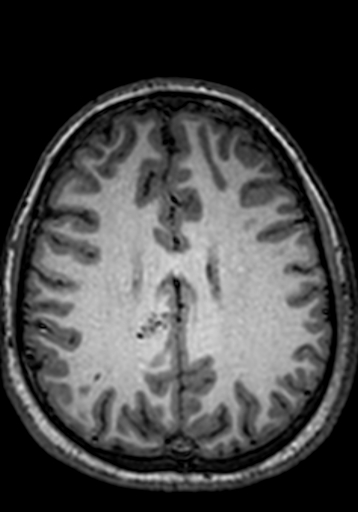 Cerebral arteriovenous malformation at posterior body of corpus callosum (Radiopaedia 74111-84925 Axial T1 93).jpg
