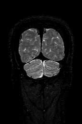 Cerebral arteriovenous malformation at posterior body of corpus callosum (Radiopaedia 74111-84925 Coronal T2 161).jpg