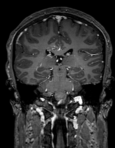 Cerebral arteriovenous malformation at posterior body of corpus callosum (Radiopaedia 74111-84925 K 223).jpg