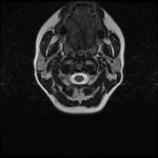 Cerebral autosomal dominant arteriopathy with subcortical infarcts and leukoencephalopathy (CADASIL) (Radiopaedia 41018-43763 Ax T2 C2-T1 2).png