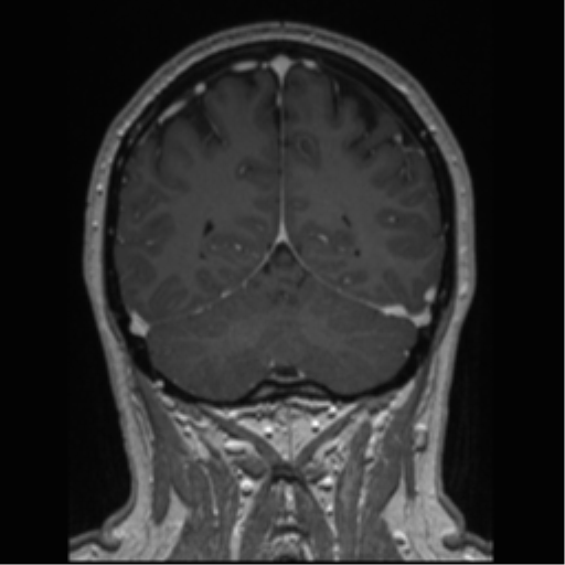 Cerebral cavernoma and development venous anomaly (Radiopaedia 37603-39482 Coronal T1 C+ 28).png