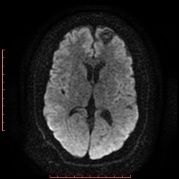 File:Cerebral cavernous malformation (Radiopaedia 26177-26306 Axial DWI 12).jpg