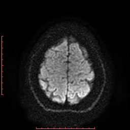 File:Cerebral cavernous malformation (Radiopaedia 26177-26306 Axial DWI 18).jpg