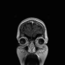 Cerebral cavernous venous malformation (Radiopaedia 70008-80021 Coronal T1 C+ 57).jpg