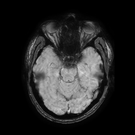 Cerebral cavernous venous malformation (Zabramski type II) (Radiopaedia 85511-101198 Axial SWI 50).jpg
