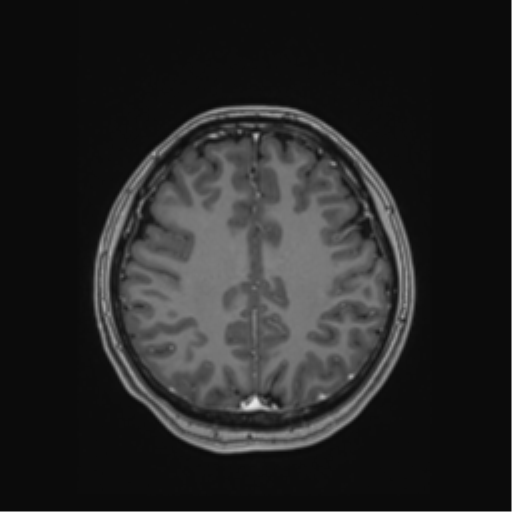 Cerebral cavernous venous malformations (Radiopaedia 48117-52946 Axial T1 C+ 44).png