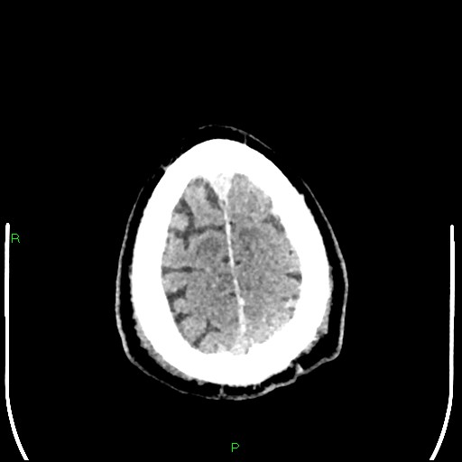 Cerebral contusions (Radiopaedia 33868-35039 Axial non-contrast 198).jpg