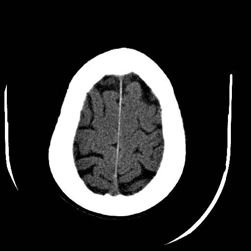 Cerebral edema (evolution in time) (Radiopaedia 19418-19440 non-contrast 81).jpg