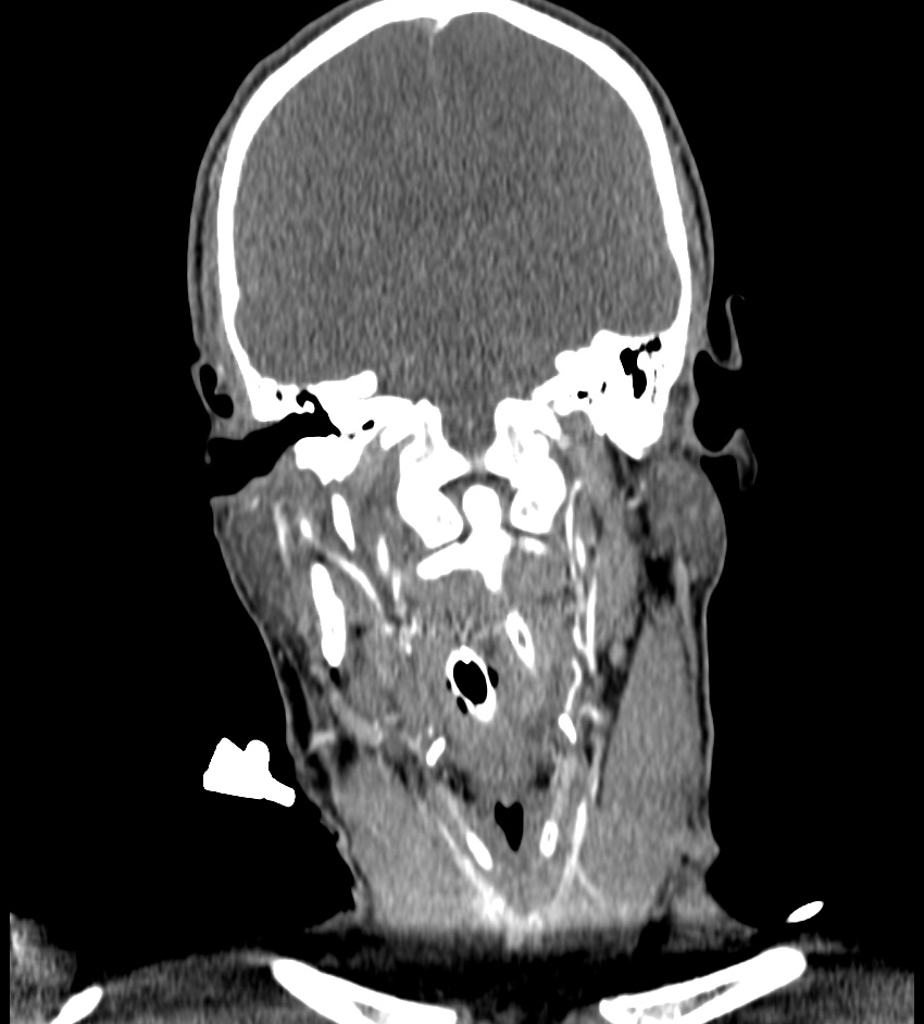 Cerebral edema in an overdose patient (Radiopaedia 72005-82539 B 68).jpg