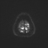 File:Cerebral embolic infarcts (embolic shower) (Radiopaedia 72391-82921 Axial DWI 59).jpg