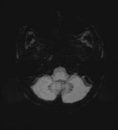 Cerebral embolic infarcts (embolic shower) (Radiopaedia 72391-82921 Axial SWI 11).jpg