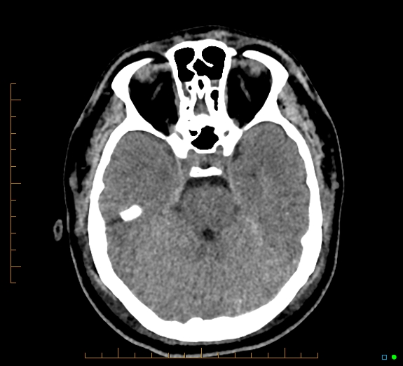 Cerebral fat embolism (Radiopaedia 85521-101224 Axial non-contrast 17).jpg