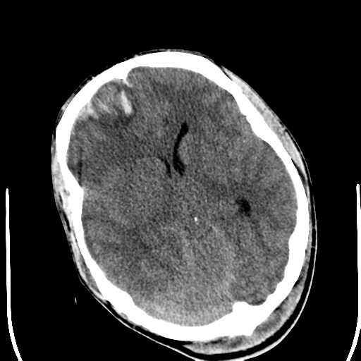 File:Cerebral hemorrhagic contusions- temporal evolution (Radiopaedia 40224-42752 Axial non-contrast 12).png