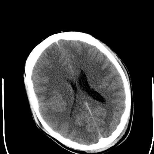File:Cerebral hemorrhagic contusions- temporal evolution (Radiopaedia 40224-42752 Axial non-contrast 17).png