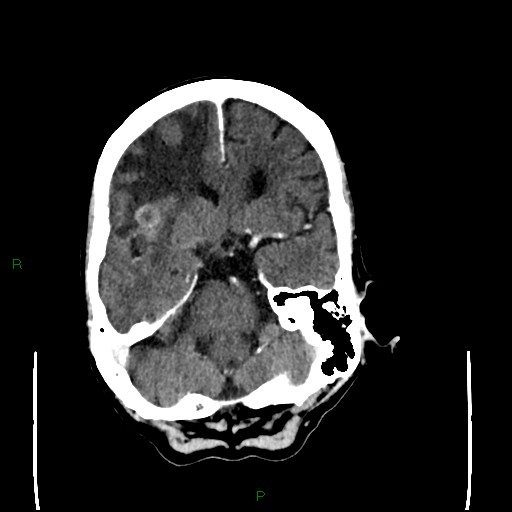 File:Cerebral metastases - breast primary (Radiopaedia 77653-89857 Axial C+ delayed 40).jpg