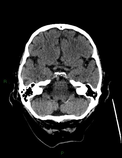 Cerebral metastases - ependymal and parenchymal (Radiopaedia 79877-93131 Axial non-contrast 16).jpg