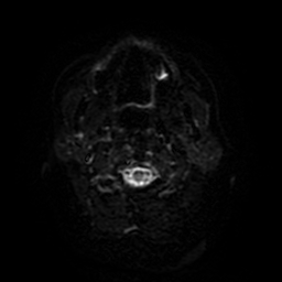 Cerebral metastases - melanoma (Radiopaedia 80972-94522 Axial DWI 65).jpg