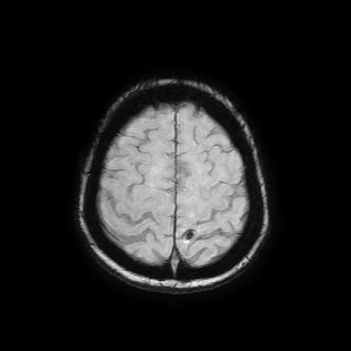 File:Cerebral metastases - melanoma (Radiopaedia 80972-94522 Axial SWI 82).jpg