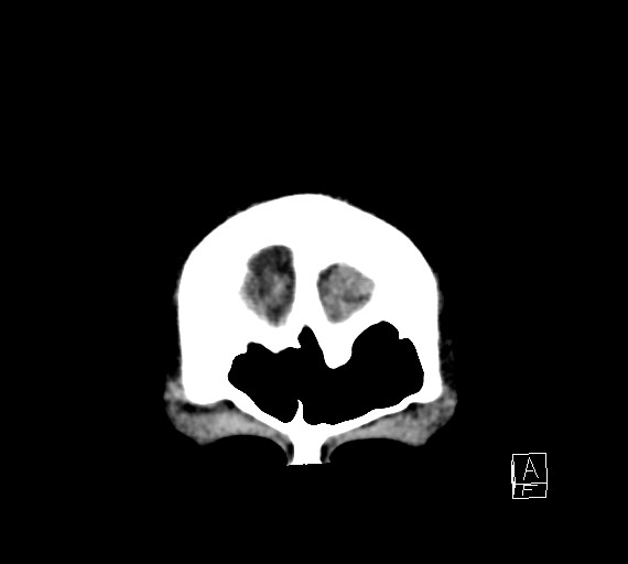 Cerebral metastases - testicular choriocarcinoma (Radiopaedia 84486-99855 Coronal C+ delayed 6).jpg