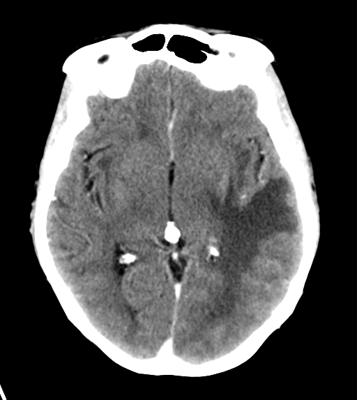 File:Cerebral metastasis (Radiopaedia 46744-51260 Axial C+ delayed 14).png