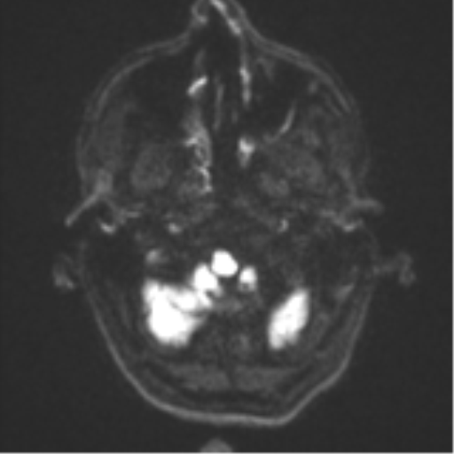 File:Cerebral metastasis - melanoma (Radiopaedia 54718-60954 Axial DWI 34).png