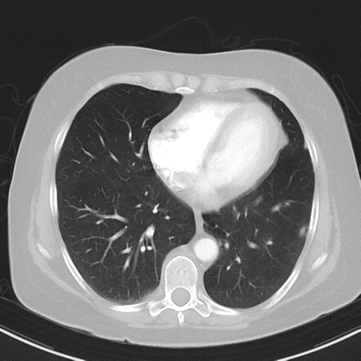 File:Cerebral metastasis mimicking glioblastoma (Radiopaedia 69155-78938 Axial lung window 31).png