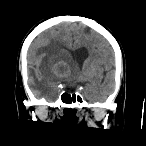 Cerebral metastasis to basal ganglia (Radiopaedia 81568-95412 Coronal non-contrast 31).png