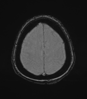 File:Cerebral metastasis to basal ganglia (Radiopaedia 81568-95413 Axial SWI magnitude 74).png