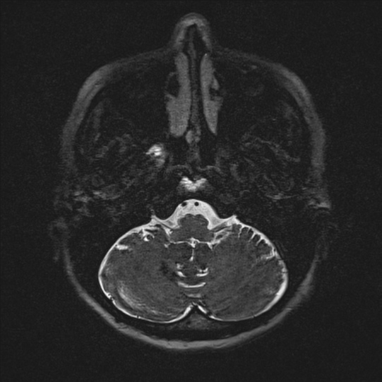 Cerebral ring enhancing lesions - cerebral metastases (Radiopaedia 44922-48817 F 13).jpg