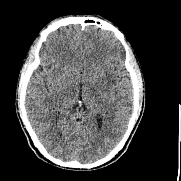 Cerebral toxoplasmosis (Radiopaedia 53993-60131 Axial non-contrast 39).jpg