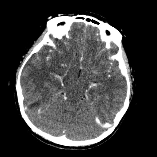 Cerebral tuberculosis with dural sinus invasion (Radiopaedia 60353-68019 Axial C+ delayed 23).jpg