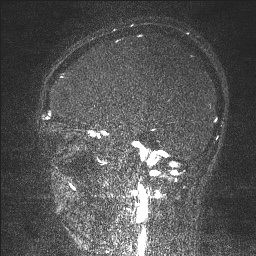 Cerebral tuberculosis with dural sinus invasion (Radiopaedia 60353-68090 Sagittal MRV 105).jpg