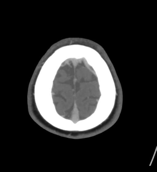 Cerebral venous infarction due to transverse sinus thrombosis (Radiopaedia 34688-36120 Axial CT venogram 46).png
