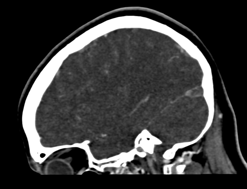 Cerebral venous sinus thrombosis (Radiopaedia 59224-66646 Sagittal C+ delayed 46).jpg