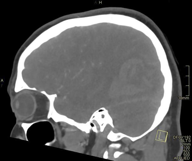 Cerebral venous sinus thrombosis (Radiopaedia 91329-108965 Sagittal venogram 55).jpg