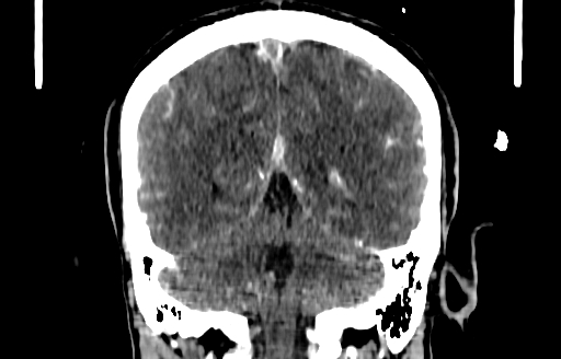 Cerebral venous thrombosis (CVT) (Radiopaedia 77524-89685 C 45).jpg