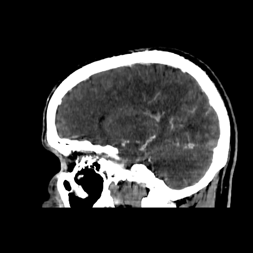 File:Cerebral venous thrombosis (CVT) (Radiopaedia 77524-89685 Sagittal CTV 15).jpg