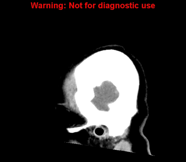 File:Cerebral venous thrombosis (Radiopaedia 37224-38992 B 29).jpg