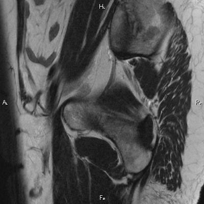 File:Cervical adenocarcinoma (Radiopaedia 65011-73985 Sagittal T2 29).jpg