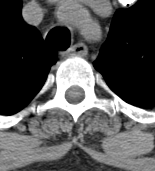 Cervical canal stenosis due to ossification of the posterior longitudinal ligament (Radiopaedia 47260-51823 Axial non-contrast 67).png